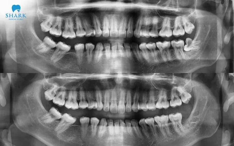 Hình ảnh trước và sau khi thực hiện nhổ răng khôn của anh Quốc Bảo tại Nha khoa Shark