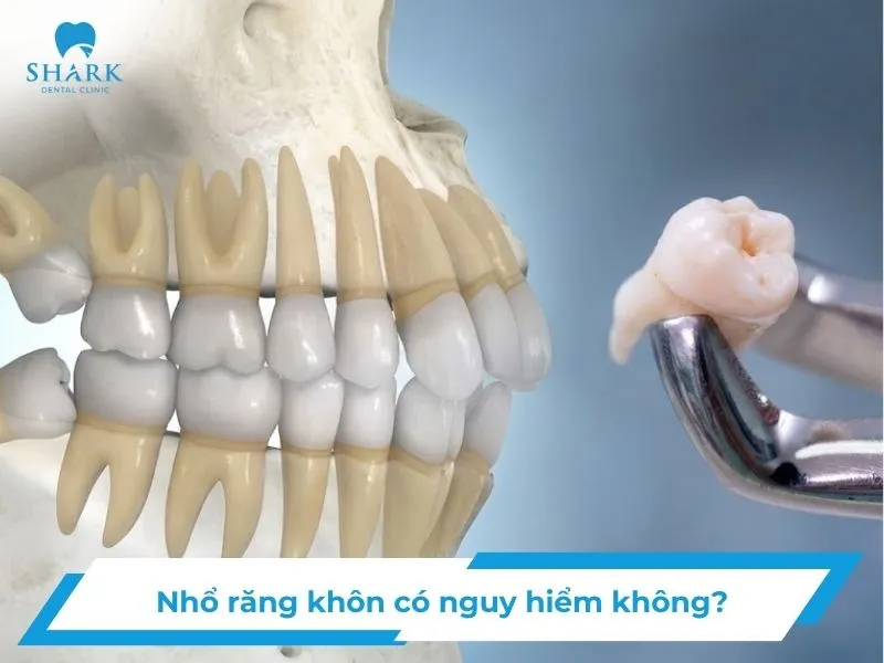Nhổ răng khôn có nguy hiểm không? Nguyên nhân và giải pháp 7 Nhổ răng khôn có nguy hiểm không? Nguyên nhân và giải pháp