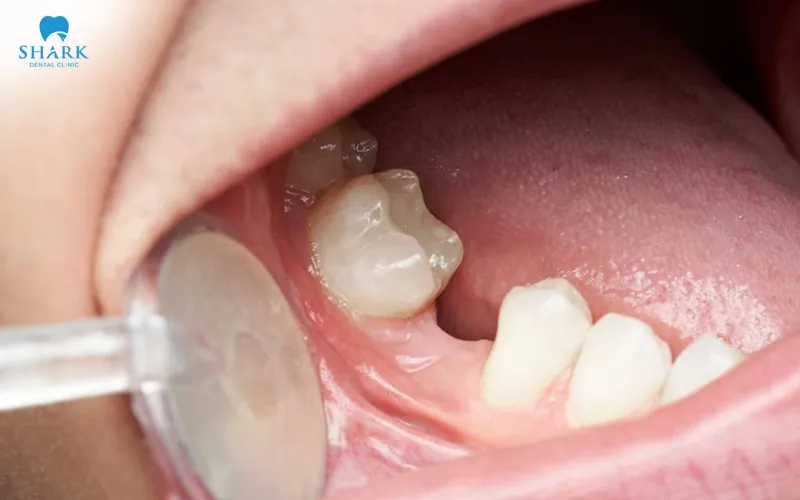 Trường hợp bị mất răng số 7 trước đó, răng số 8 sẽ được tận dụng để di chuyển vào vị trí răng đã mất