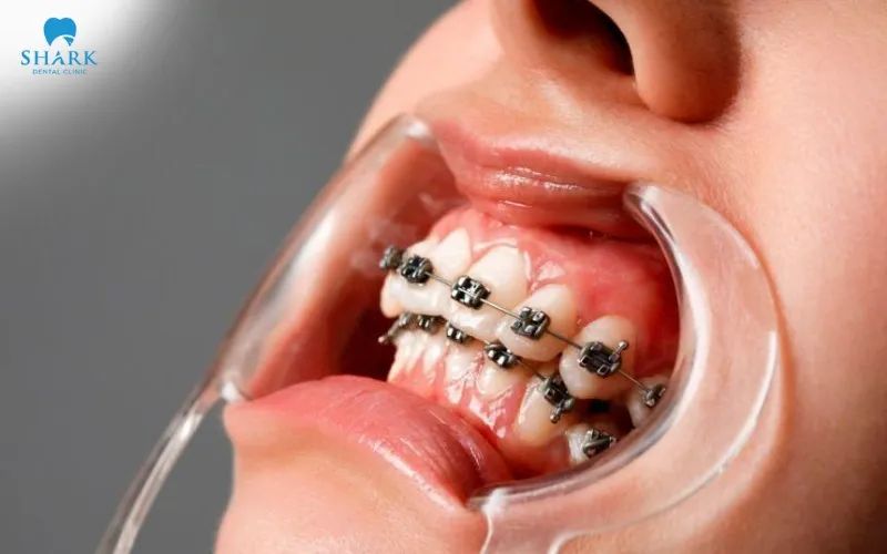 Nhổ răng khôn giúp bảo vệ kết quả niềng răng và hạn chế tình trạng xô lệch răng trở lại sau khi tháo niềng