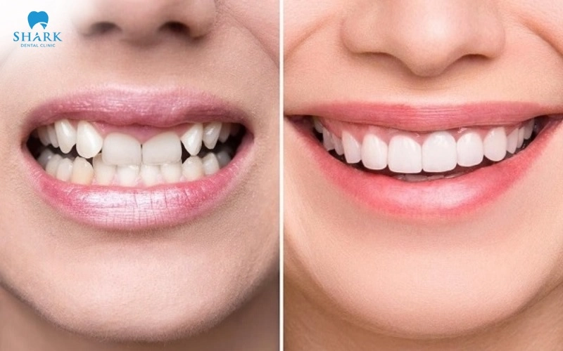 Nguyên nhân răng cửa quặp vào trong là gì? Cách điều trị 5 Hình ảnh răng cửa quặp vào trong so với răng cửa mọc thẳng bình thường