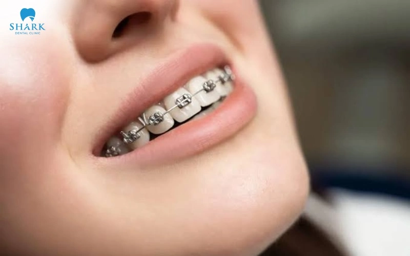 Nguyên nhân răng cửa quặp vào trong là gì? Cách điều trị 7 So sánh bọc răng sứ và niềng răng cửa quặp vào trong