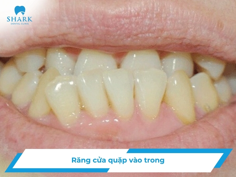 rang cua quap vao trong