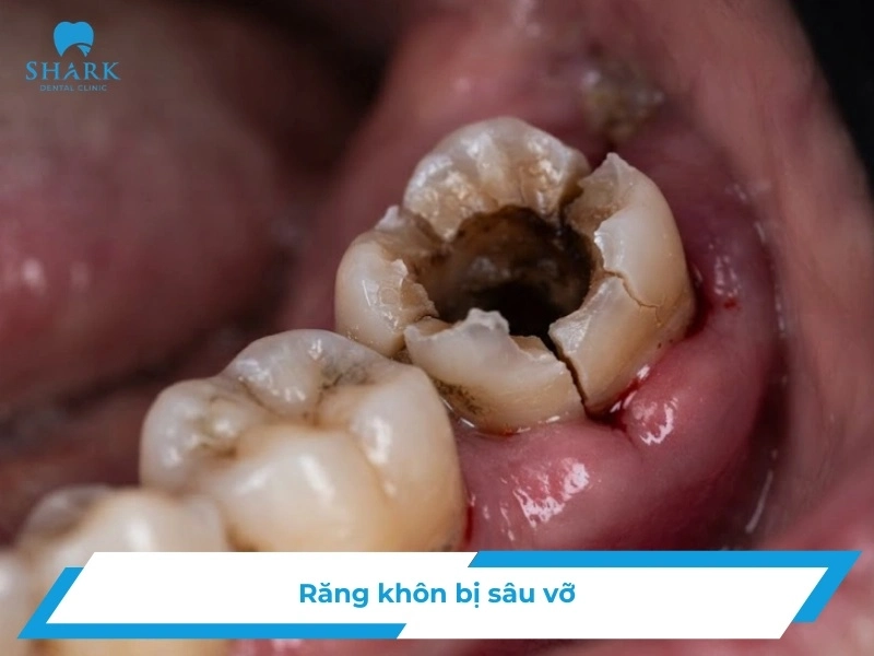 Răng khôn bị sâu vỡ có nguy hiểm không? Tại sao nên nhổ? 11 Răng khôn bị sâu vỡ