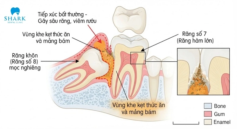 Răng khôn bị sâu vỡ có nguy hiểm không? Tại sao nên nhổ? 7 Sơ đồ răng khôn mọc nghiêng gây sâu mặt xa răng số 7