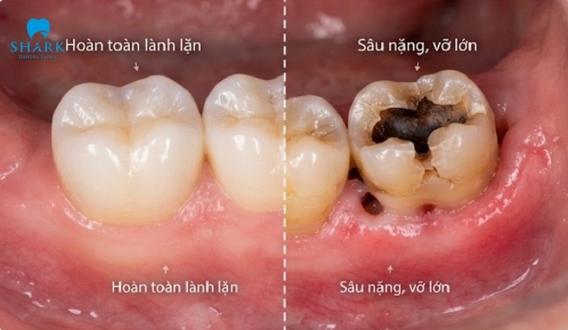 Răng khôn bị sâu vỡ có nguy hiểm không? Tại sao nên nhổ? 5 Răng khôn bị vỡ