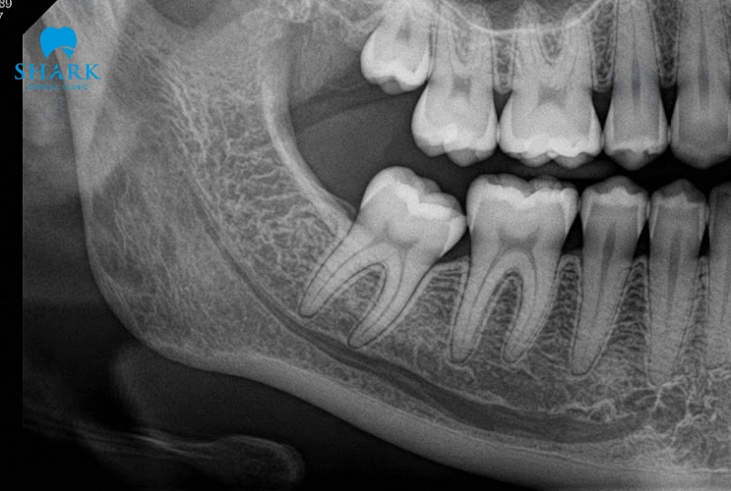 Răng khôn có mấy chân? Các kiểu chân răng thường gặp nhất 6 Phim X-quang chụp số chân của răng khôn