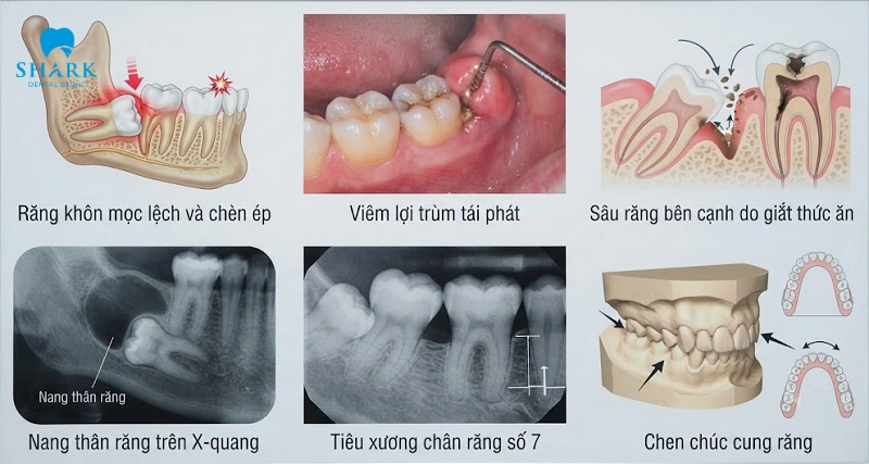 Răng khôn có mấy chân? Các kiểu chân răng thường gặp nhất 7 Trường hợp nhổ răng khôn