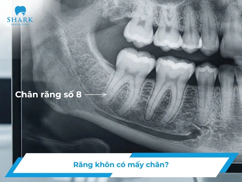 Răng khôn có mấy chân? Các kiểu chân răng thường gặp nhất 13 Răng khôn có mấy chân