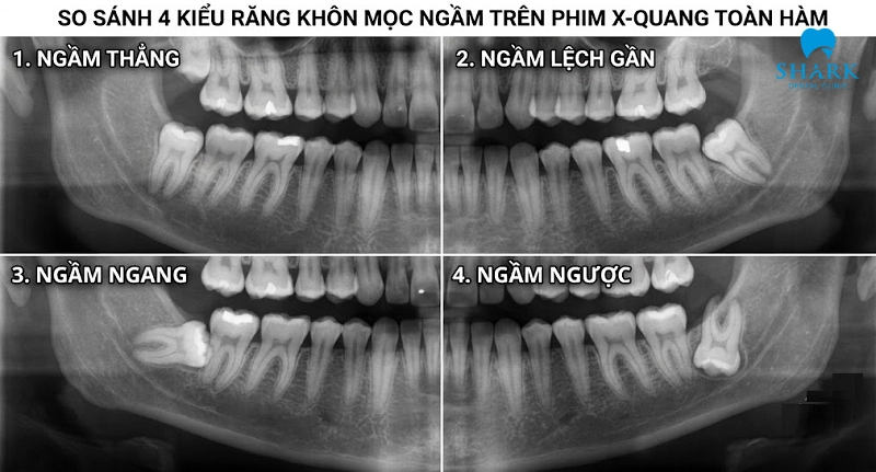 Dấu hiệu nhận biết răng khôn mọc ngầm và khi nào cần nhổ? 7 Các dạng răng khôn mọc ngầm thẳng, lệch gần, ngang và ngược trên phim X-quang