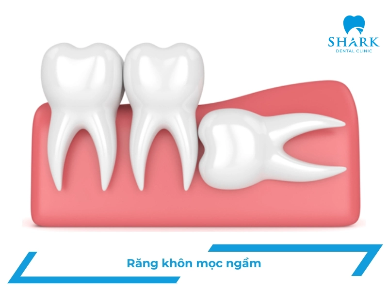 Răng khôn mọc ngầm