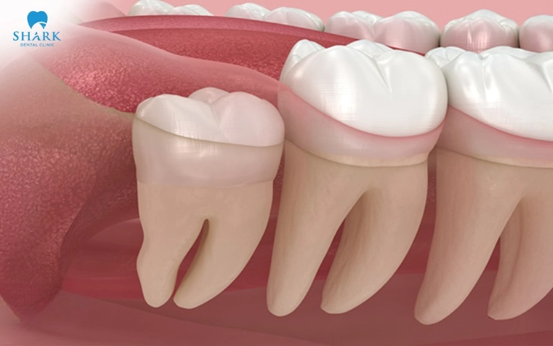 Răng khôn mọc thẳng có nên nhổ không? Khi nào cần nhổ? 4 Răng khôn mọc thẳng