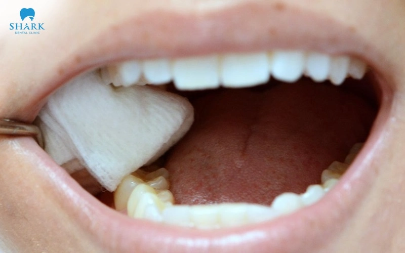 Răng khôn mọc thẳng có nên nhổ không? Khi nào cần nhổ? 6 Cắn gạc theo đúng chỉ định từ bác sĩ sau khi nhổ răng khôn