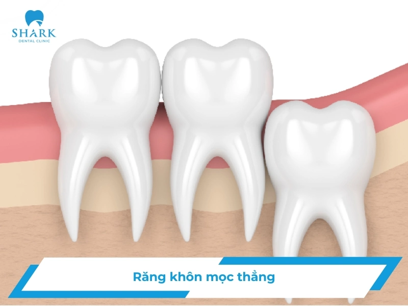 Răng khôn mọc thẳng