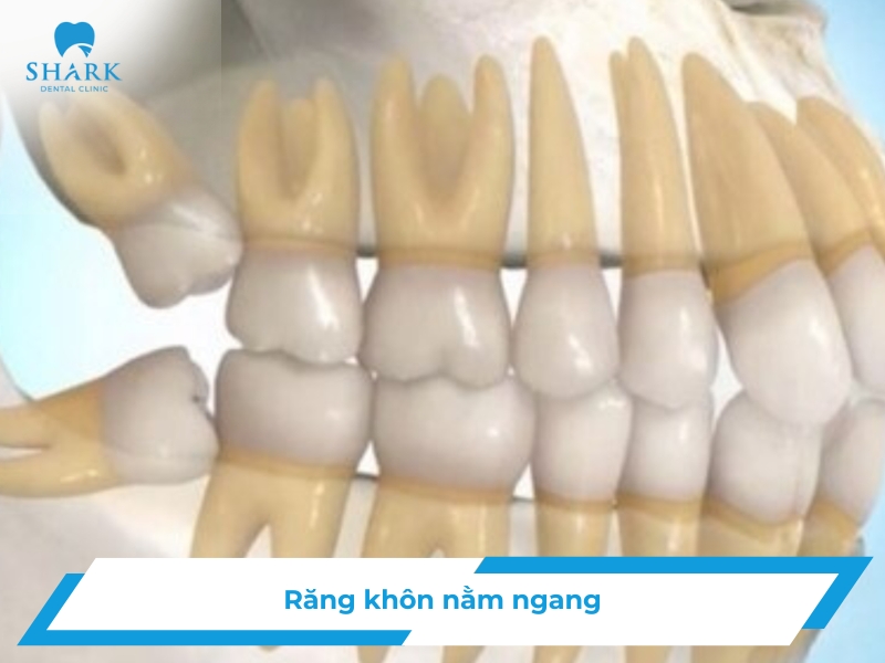 Răng khôn nằm ngang có nên nhổ không? Có nguy hiểm không? 19 Răng khôn nằm ngang