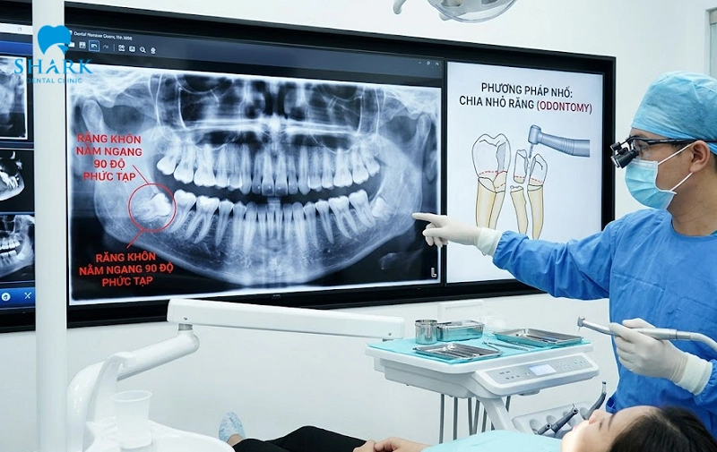Răng khôn nằm ngang có nên nhổ không? Có nguy hiểm không? 9 Răng khôn nằm ngang 90 độ