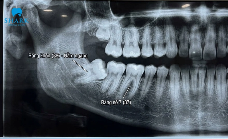 Răng khôn nằm ngang có nên nhổ không? Có nguy hiểm không? 7 Răng khôn nằm ngang đâm vào răng số 7