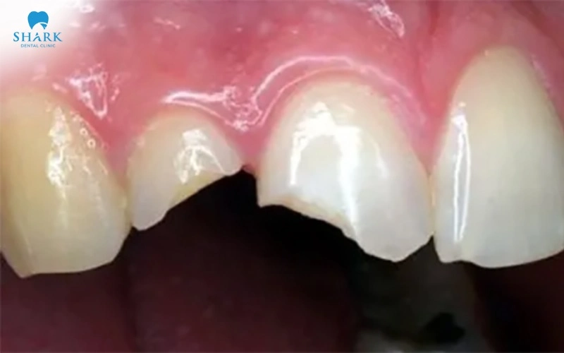 Răng bị mẻ do va chạm khi nhai vật cứng