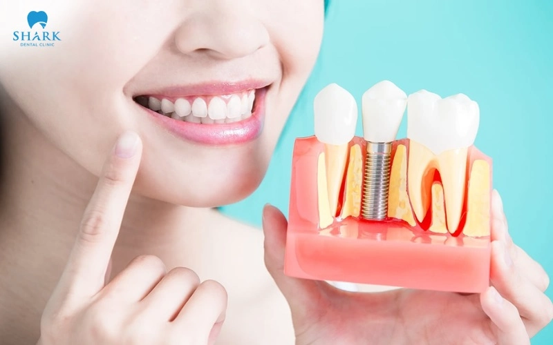 Cấy Implant là phương pháp trồng răng cửa số 2 tối ưu nhất
