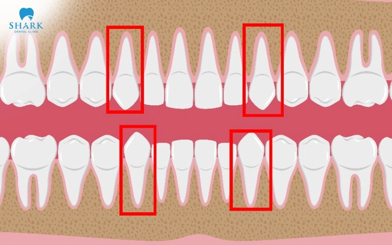 Răng số 3 là răng nào? Giá trồng răng nanh khi bị mất? 8 Mô tả vị trí răng số 3