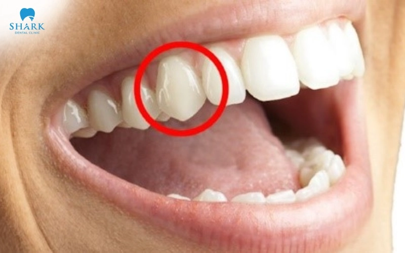 Răng số 3 là răng nào? Giá trồng răng nanh khi bị mất? 9 Cấu tạo răng số 3