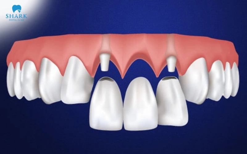 Răng số 3 là răng nào? Giá trồng răng nanh khi bị mất? 12 Cầu răng sứ