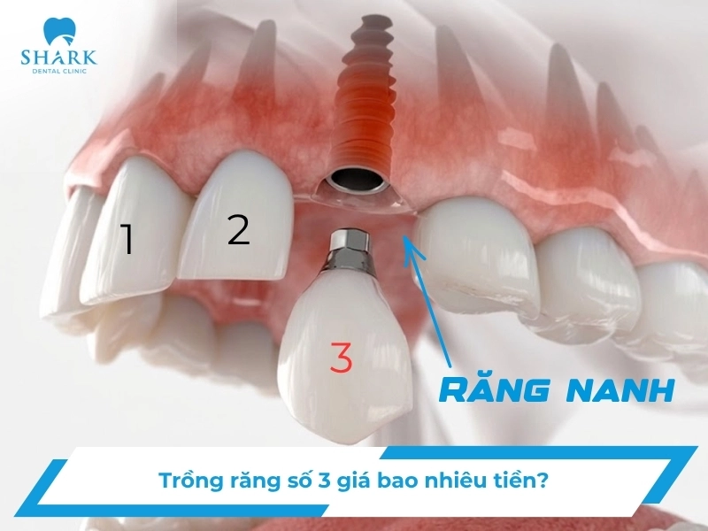 Răng số 3 là răng nào? Giá trồng răng nanh khi bị mất? 12 Trồng răng số 3