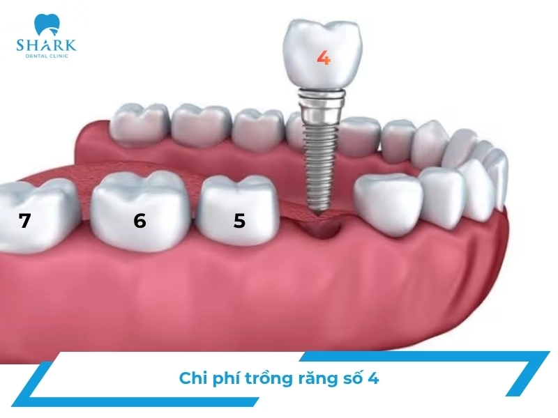 Răng số 4 là răng nào? Giá trồng răng số 4 là bao nhiêu? 11 Răng số 4