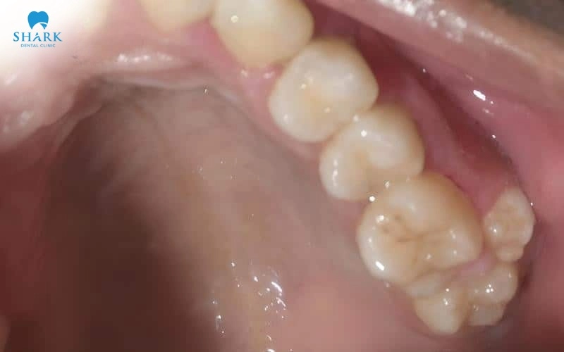 Răng số 9 là răng gì? Có nên nhổ răng số 9 không? 7 Răng số 9 là chiếc răng mọc thừa trên cung hàm