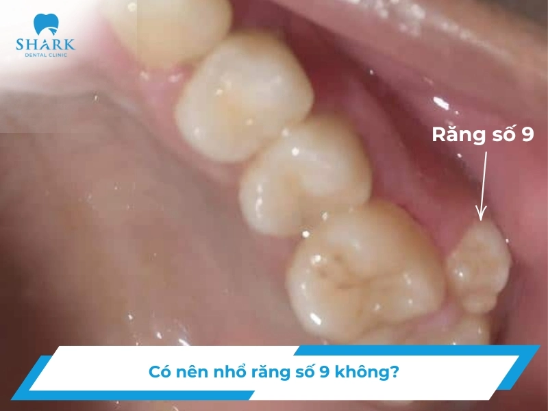 Răng số 9 là răng gì? Có nên nhổ răng số 9 không? 13 Răng số 9