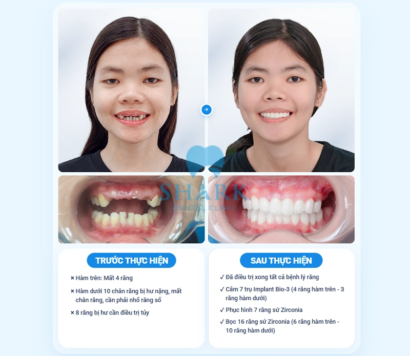 Giá bọc răng sứ Zirconia bao nhiêu tiền? Bảng giá 2026 10 Bảo Ngân bọc sứ tại Nha khoa Shark