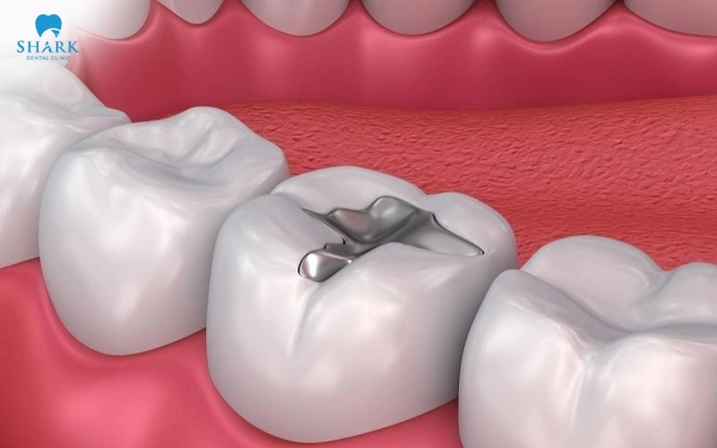 Răng trám có tẩy trắng được không? Cách khắc phục hiệu quả 6 Không thể tẩy trắng răng trám vì thuốc tẩy trắng răng chỉ phát huy tác dụng trên mô răng thật