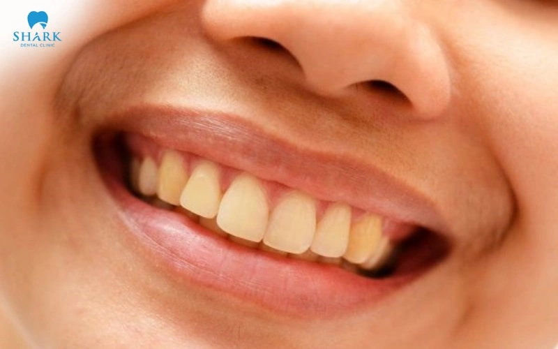 Răng trám có tẩy trắng được không? Cách khắc phục hiệu quả 8 Nếu bạn cố ý tự tẩy trắng tại nhà thì răng của bạn có thể vẫn giữ nguyên màu cũ và khiến nụ cười kém tự nhiên hơn