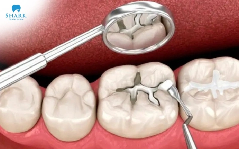 Răng trám có tẩy trắng được không? Cách khắc phục hiệu quả 9 Thay miếng trám mới là phương pháp được áp dụng phổ biến và mang lại hiệu quả thẩm mỹ cao