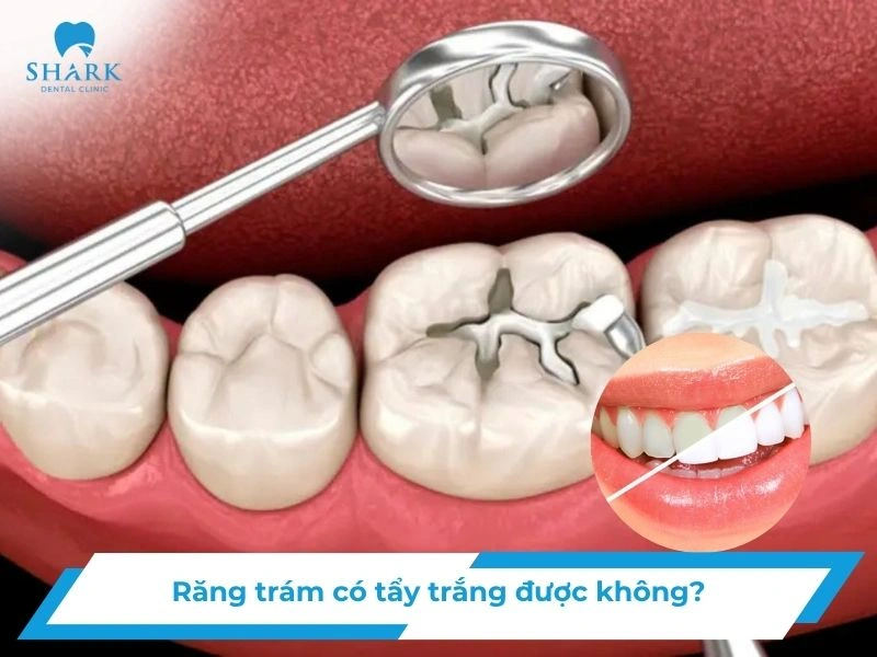 răng trám có tẩy trắng được không