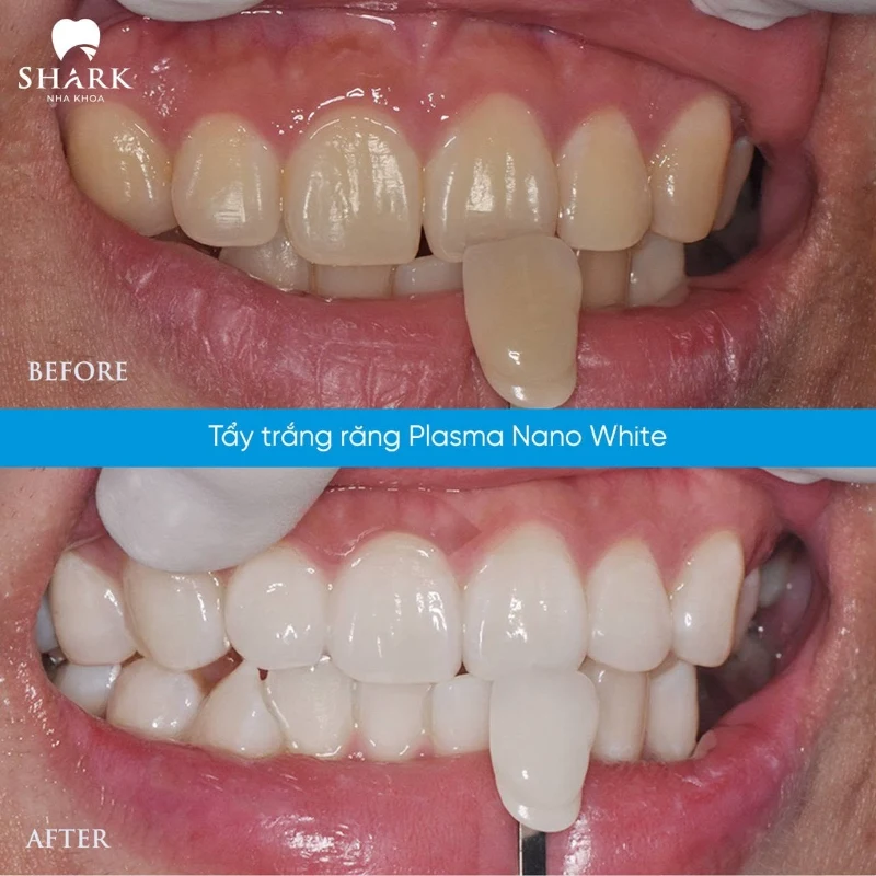 Răng xỉn màu do đâu? Cách khắc phục răng bị xỉn màu? 11 Răng của anh Minh trước và sau khi tẩy trắng răng tại Nha khoa Shark