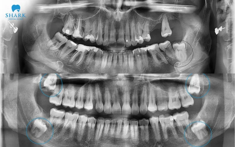 Hình ảnh chụp cho thấy chiếc răng khôn của anh Bách có dấu hiệu mọc lệch và tạo một túi mủ sâu bên dưới nướu