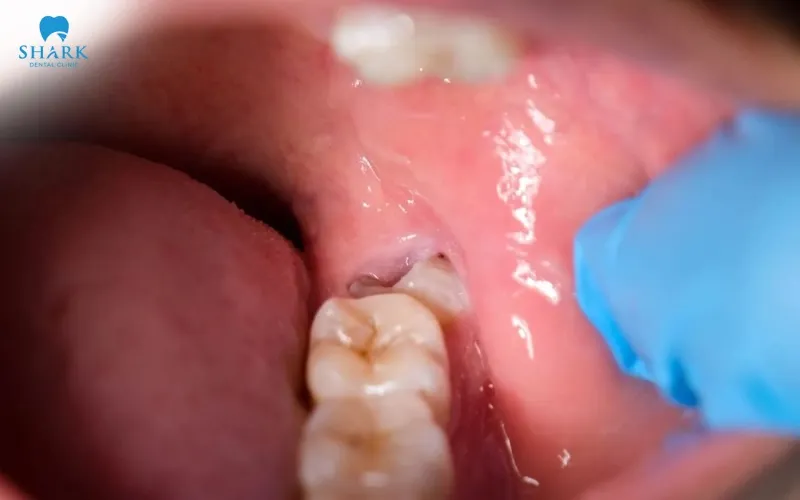 Nguyên nhân dẫn đến tình trạng này là do răng khôn mọc lệch, mọc ngầm, kẹt lại trong nướu gây sưng viêm