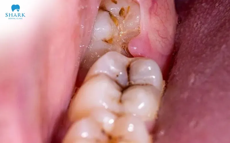 Răng khôn mọc lệch có thể gây chèn ép lên răng kế cận gây ảnh hưởng đến cấu trúc răng