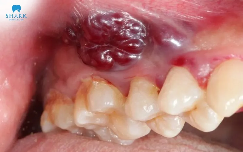 Nhiễm trùng huyết là một biến chứng nguy hiểm có thể gây ảnh hưởng đến sức khỏe toàn thân