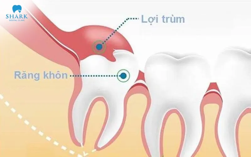 Với trường hợp răng khôn mọc thẳng nhưng bị lợi trùm có thể được chỉ định cắt lợi trùm để hạn chế tình trạng viêm tái phát