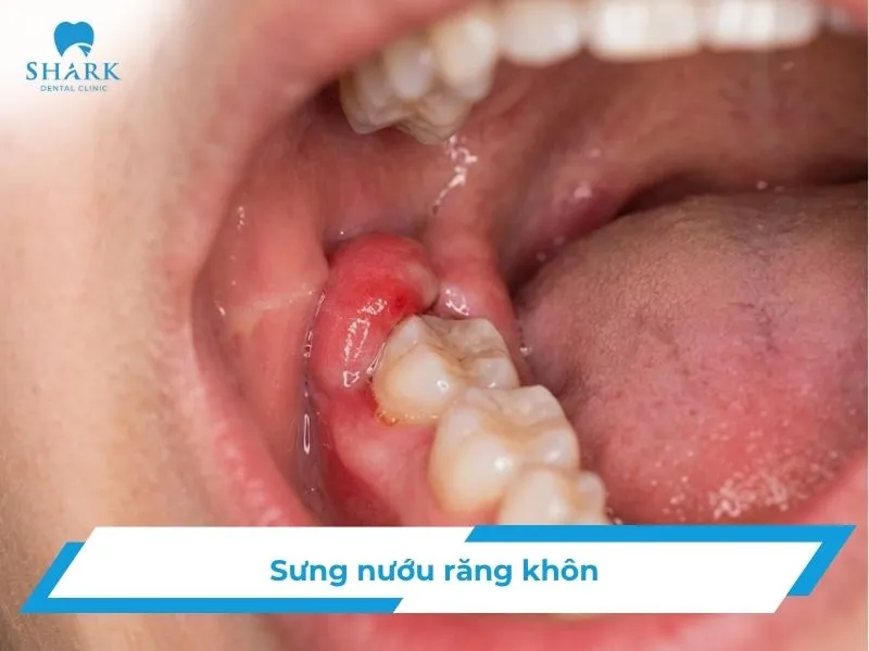 Sưng nướu răng khôn: Nguyên nhân và cách điều trị hiệu quả 29 Sưng nướu răng khôn: Nguyên nhân và cách điều trị hiệu quả