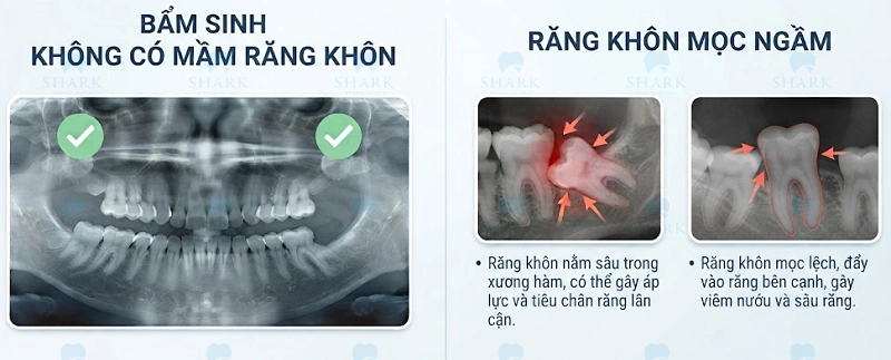 Tại sao có người không mọc răng khôn? Nguyên nhân là gì? 5 Răng khôn mọc ngầm cần được chụp X-quang và sẽ có chỉ định nhổ hoặc không từ bác sĩ