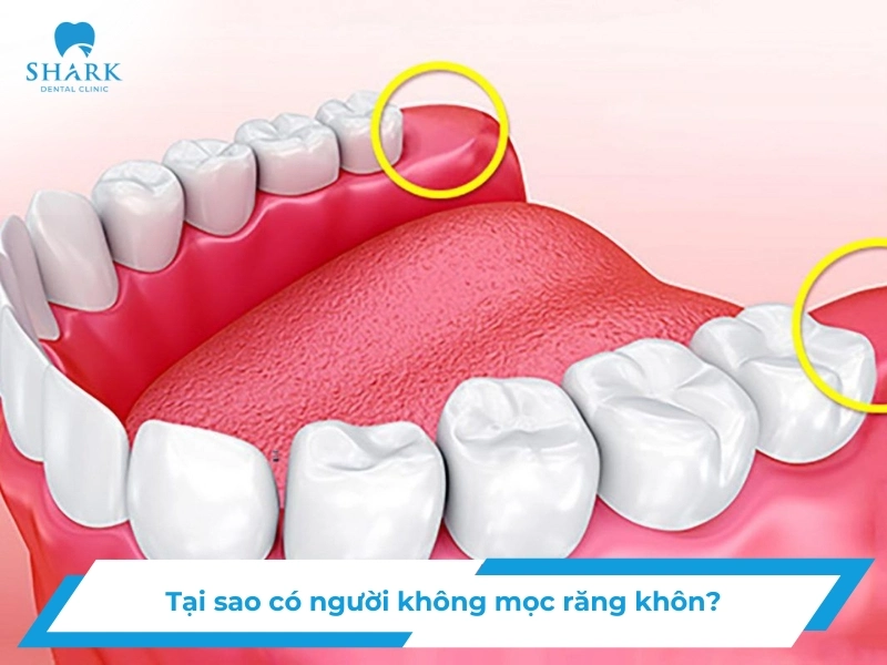 Tại sao có người không mọc răng khôn