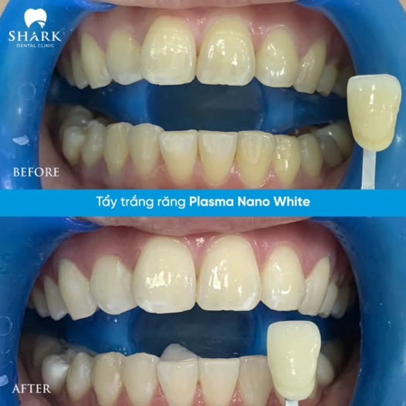 Tẩy trắng răng bằng đèn Plasma 1h là gì? Có hiệu quả không? 8 Răng của chị Oanh trước và sau khi tẩy trắng răng bằng phương pháp Plasma