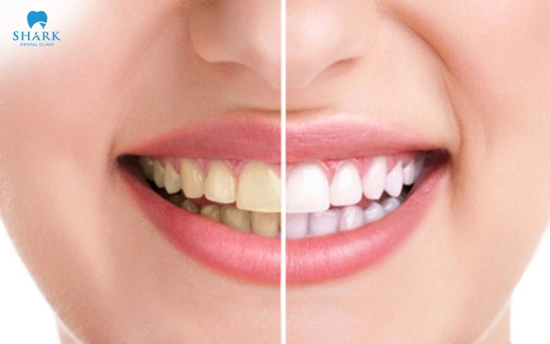 Tẩy trắng răng Brite Smile có tốt không? Giá bao nhiêu tiền? 8 Phù hợp với những người có răng bị ố vàng, xỉn màu do thực phẩm, đồ uống có màu, hút thuốc lá hoặc vệ sinh răng miệng chưa đúng cách