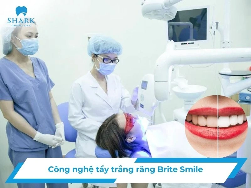 Tẩy trắng răng Brite Smile có tốt không? Giá bao nhiêu tiền? 17 công nghệ tẩy trắng Brite Smile