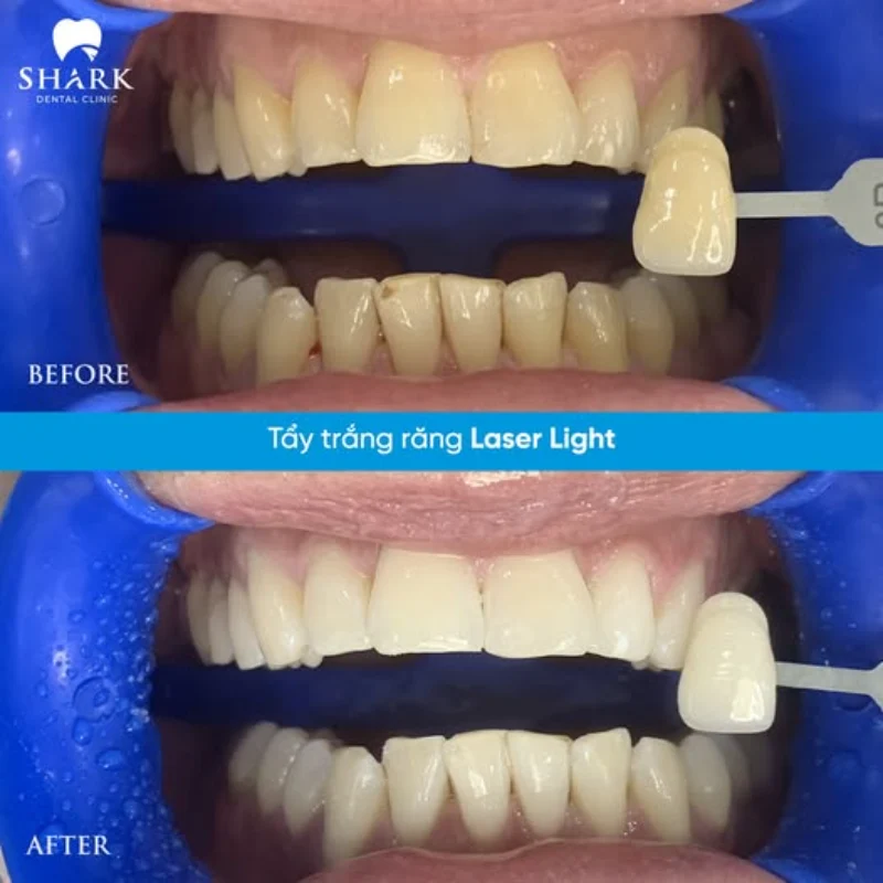 Tẩy trắng răng giá bao nhiêu tiền? Bảng giá mới 2026 6 Răng của chị Minh Anh trước và sau khi tẩy trắng tại Nha khoa Shark