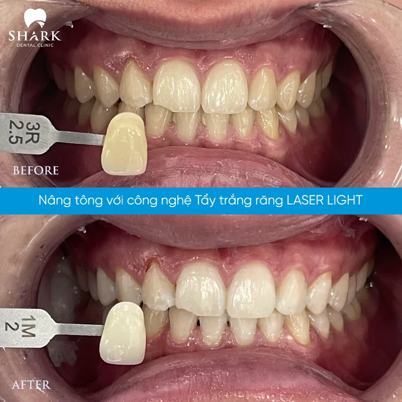 Tẩy trắng răng bằng Laser là gì? Giá bao nhiêu tiền một lần? 18 Răng của anh Hoàng trước và sau khi tẩy trắng răng Laser khắc phục men răng ố vàng tại Nha khoa Shark