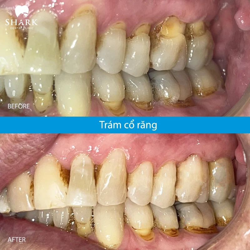 Mòn cổ chân răng là gì? Trám cổ chân răng bao nhiêu tiền? 16 Răng của anh Luân trước và sau khi thực hiện trám cổ chân răng
